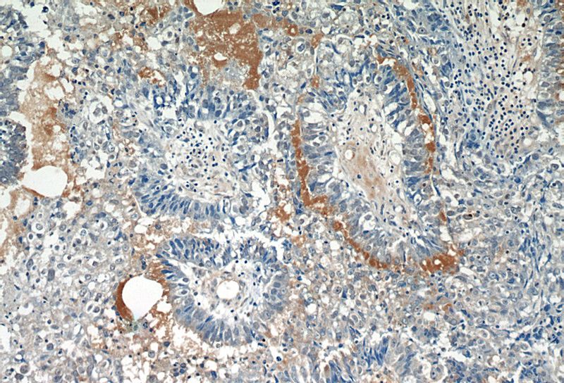 Immunohistochemistry of paraffin-embedded human breast cancer tissue slide using Catalog No:110396(EPSTI1 Antibody) at dilution of 1:50 (under 10x lens)