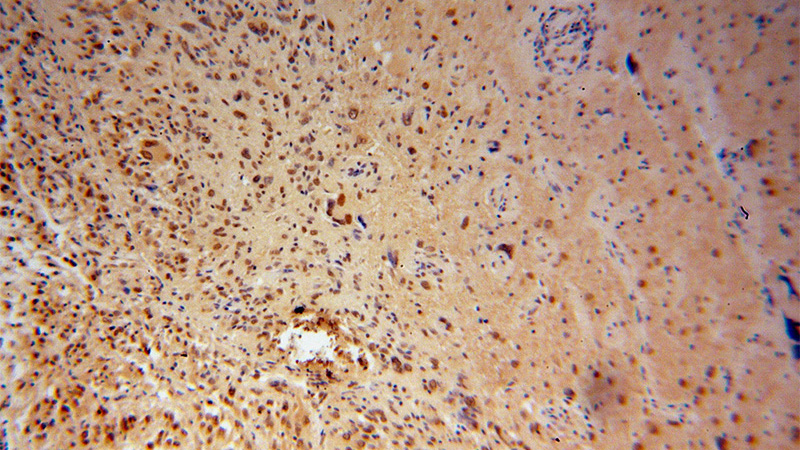 Immunohistochemical of paraffin-embedded human gliomas using Catalog No:117241(POU3F2 antibody) at dilution of 1:100 (under 10x lens)