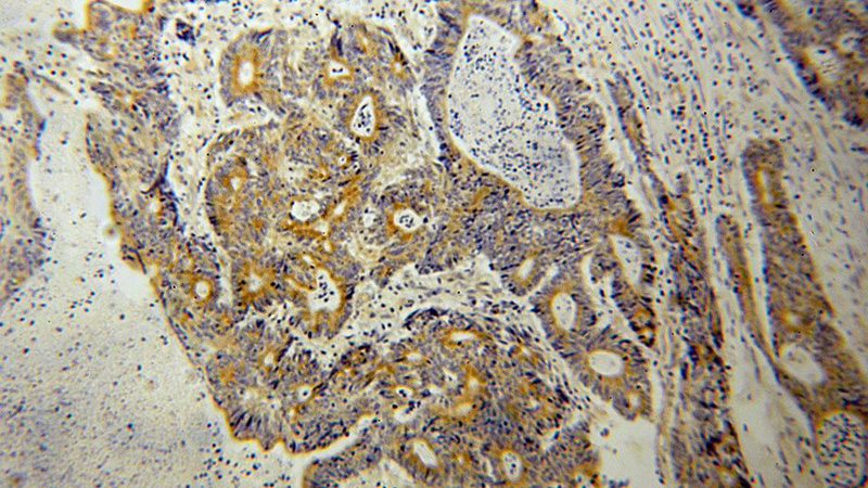 Immunohistochemical of paraffin-embedded human colon cancer using Catalog No:113534(BCAR1 antibody) at dilution of 1:100 (under 10x lens)