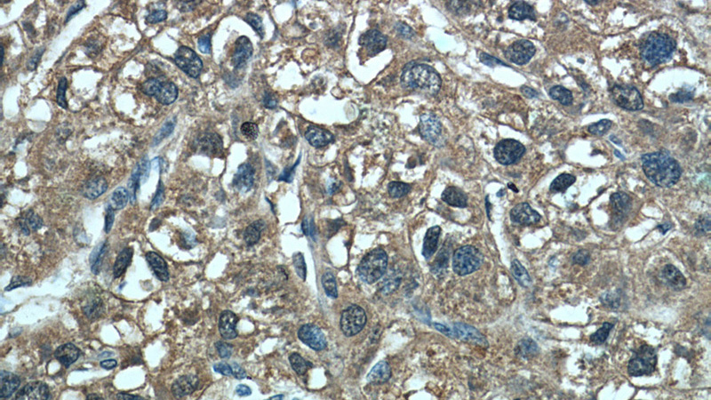 Immunohistochemistry of paraffin-embedded human liver cancer tissue slide using Catalog No:109917(DHFR Antibody) at dilution of 1:50 (under 40x lens)