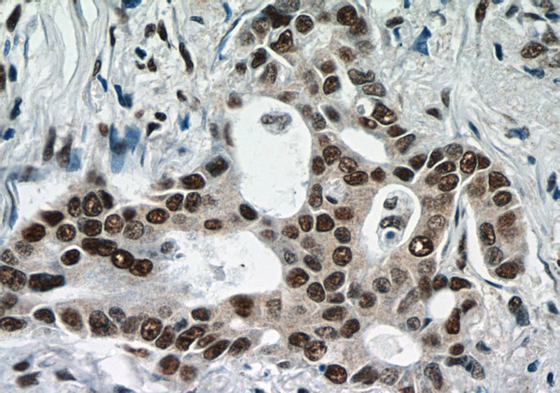 Immunohistochemistry of paraffin-embedded human lung cancer tissue slide using Catalog No:111556(HSF1 Antibody) at dilution of 1:50 (under 40x lens)
