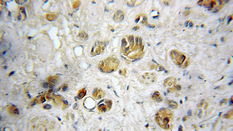 Immunohistochemical of paraffin-embedded human prostate cancer using Catalog No:114333(PTRH2 antibody) at dilution of 1:10 (under 25x lens)