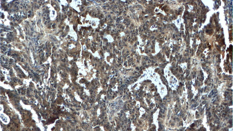 Immunohistochemistry of paraffin-embedded human ovary tumor tissue slide using Catalog No:113022(NANS Antibody) at dilution of 1:100 (under 10x lens).