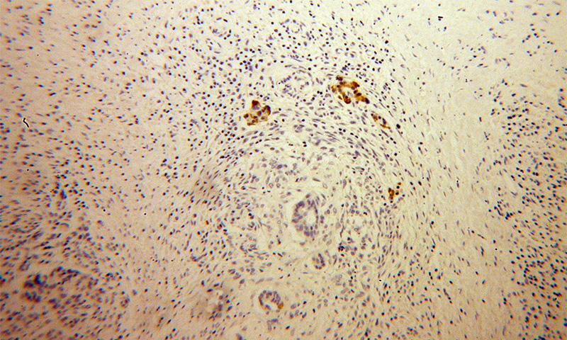 Immunohistochemical of paraffin-embedded human pancreas cancer using Catalog No:112757(MPV17 antibody) at dilution of 1:50 (under 10x lens)
