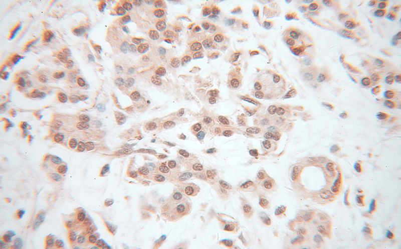 Immunohistochemical of paraffin-embedded human pancreas cancer using Catalog No:114565(RBPJ antibody) at dilution of 1:100 (under 40x lens)