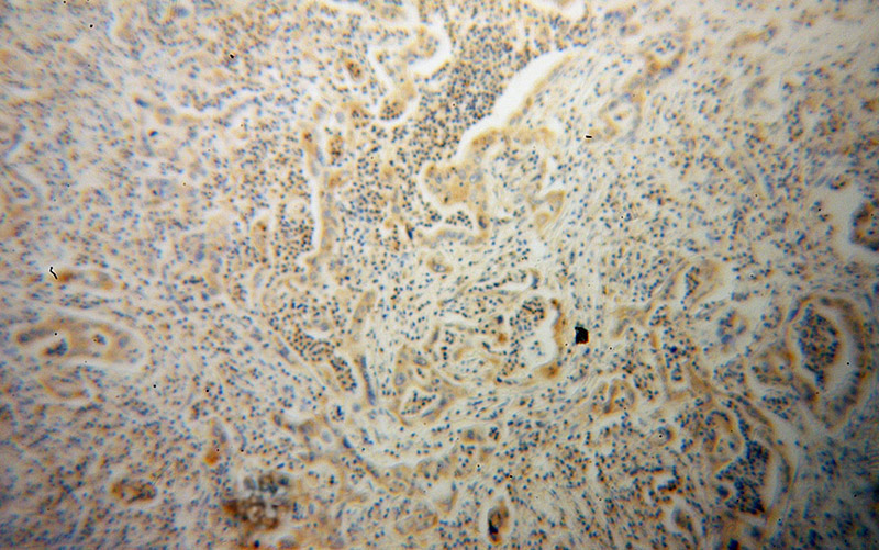 Immunohistochemical of paraffin-embedded human pancreas cancer using Catalog No:107361(KEAP1 antibody) at dilution of 1:100 (under 10x lens)