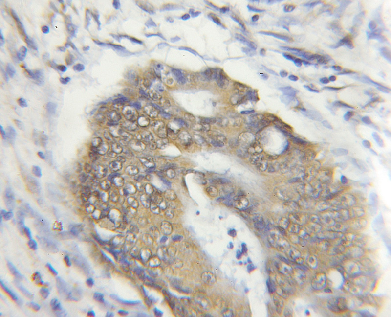 Immunohistochemical of paraffin-embedded human colon cancer using Catalog No:110399(ERAL1 antibody) at dilution of 1:50 (under 10x lens)