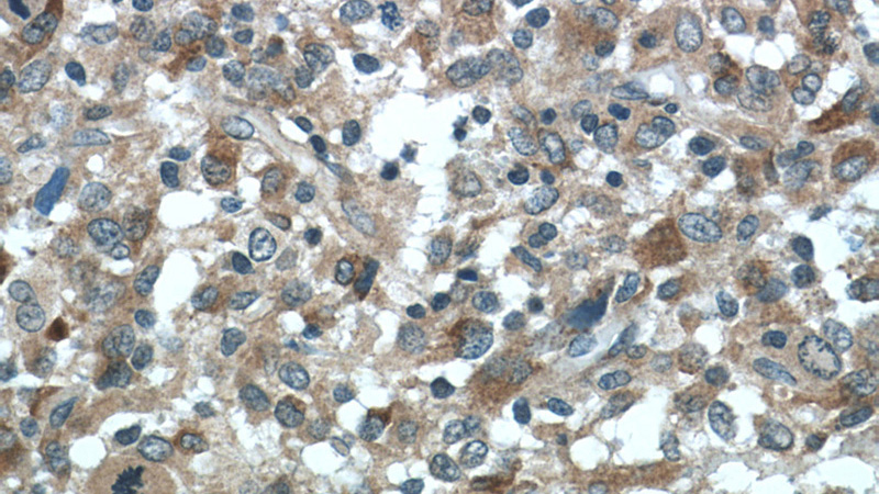 Immunohistochemistry of paraffin-embedded human gliomas tissue slide using Catalog No:115544(SPARCL1 Antibody) at dilution of 1:50 (under 40x lens)