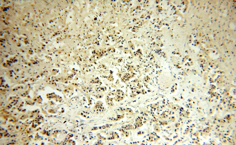 Immunohistochemical of paraffin-embedded human breast cancer using Catalog No:114149(PPP1R13L antibody) at dilution of 1:100 (under 10x lens)