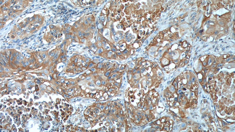 Immunohistochemistry of paraffin-embedded human lung cancer tissue slide using (SLC2A1,GLUT1 Antibody) at dilution of 1:300 (under 10x lens).