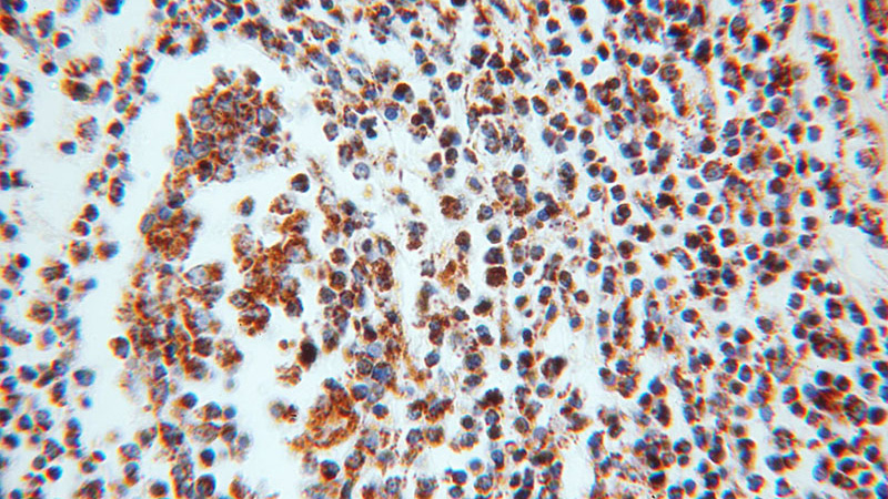 Immunohistochemical of paraffin-embedded human prostate using Catalog No:113087(NDUFV2 antibody) at dilution of 1:50 (under 40x lens)