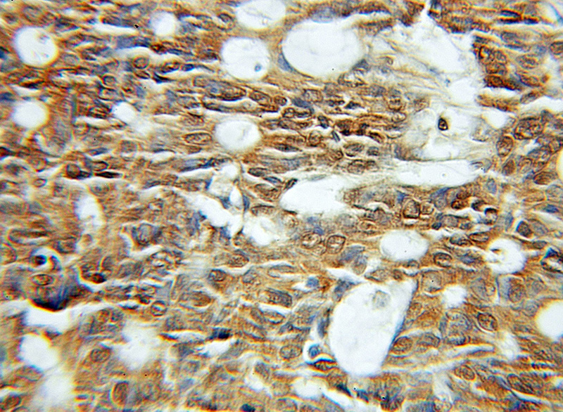 Immunohistochemical of paraffin-embedded human colon cancer using Catalog No:109673(CYPA antibody) at dilution of 1:200 (under 10x lens)