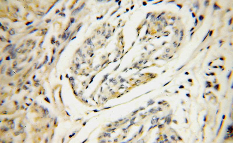 Immunohistochemical of paraffin-embedded human endometrial cancer using Catalog No:115195(SERP1 antibody) at dilution of 1:100 (under 40x lens)