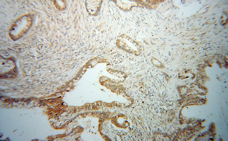 Immunohistochemical of paraffin-embedded human colon cancer using Catalog No:109194(CES3 antibody) at dilution of 1:100 (under 10x lens)