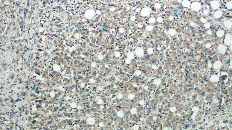 Immunohistochemistry of paraffin-embedded human stomach cancer tissue slide using Catalog No:109885(DEFB121 Antibody) at dilution of 1:50 (under 10x lens)