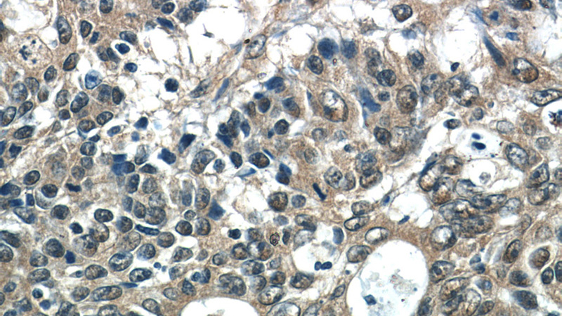 Immunohistochemistry of paraffin-embedded human colon cancer tissue slide using Catalog No:114992(SCFD2 Antibody) at dilution of 1:50 (under 40x lens)
