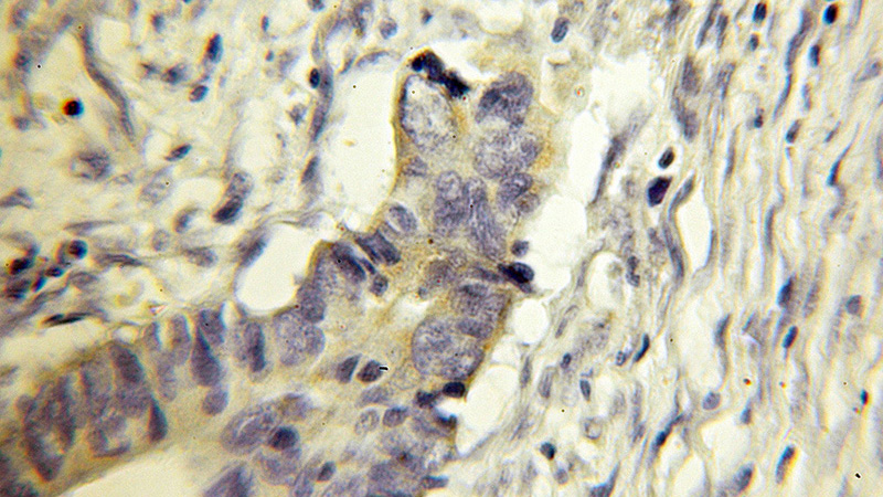 Immunohistochemical of paraffin-embedded human colon cancer using Catalog No:110065(DPH2 antibody) at dilution of 1:50 (under 10x lens)