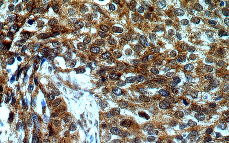 Immunohistochemical of paraffin-embedded human cervical cancer using Catalog No:110079(DNA2 antibody) at dilution of 1:50 (under 40x lens)