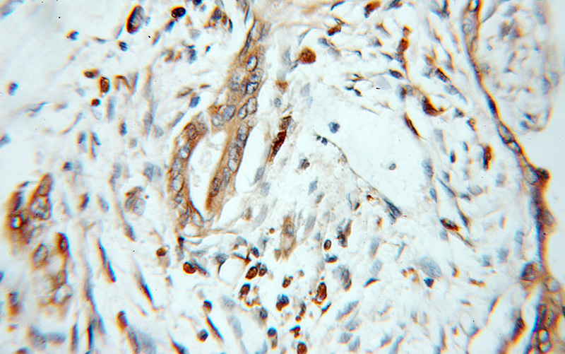 Immunohistochemical of paraffin-embedded human pancreas cancer using Catalog No:117172(ZNF395 antibody) at dilution of 1:100 (under 10x lens)