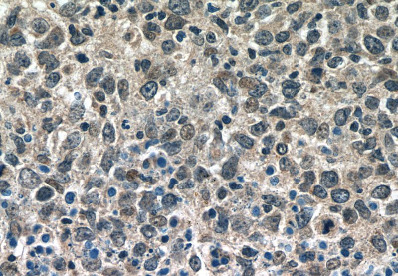 Immunohistochemistry of paraffin-embedded human lymphoma tissue slide using Catalog No:117101(BCL3 Antibody) at dilution of 1:50 (under 40x lens)