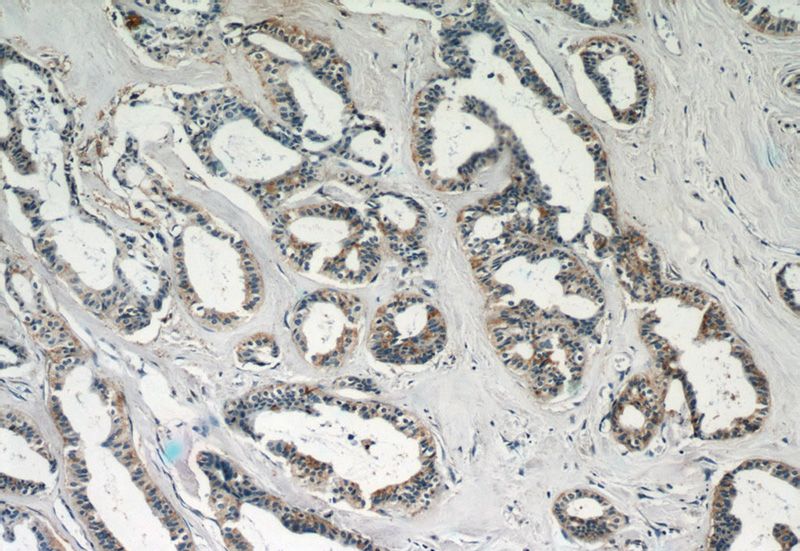 Immunohistochemistry of paraffin-embedded human breast cancer slide using Catalog No:112204(LGALS3BP Antibody) at dilution of 1:50 (under 10x lens)