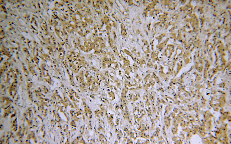 Immunohistochemical of paraffin-embedded human breast cancer using Catalog No:115262(SH3PXD2A antibody) at dilution of 1:50 (under 10x lens)
