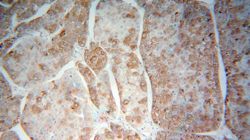 Immunohistochemical of paraffin-embedded human liver cancer using Catalog No:109533(CPVL antibody) at dilution of 1:200 (under 10x lens)