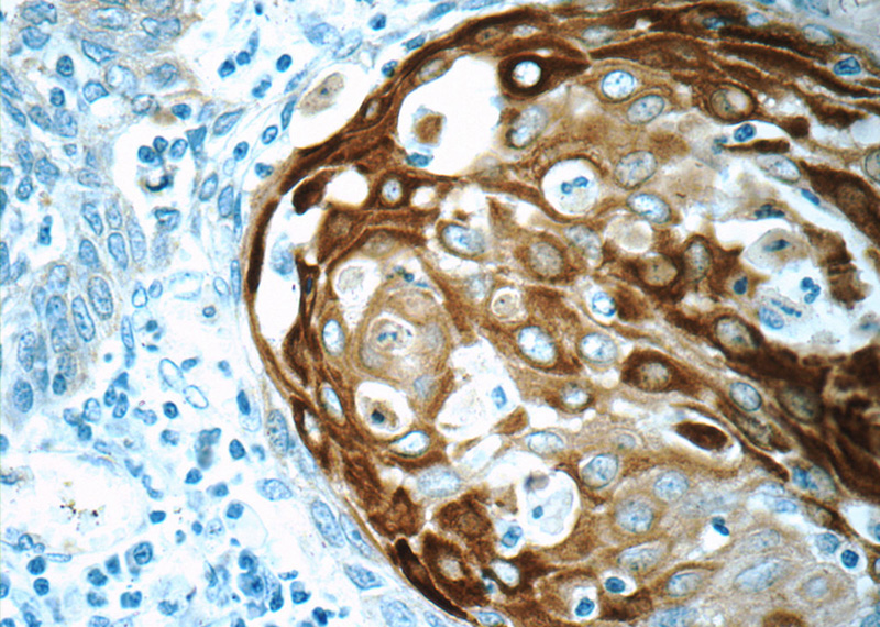 Immunohistochemistry of paraffin-embedded human oesophagus cancer tissue slide using Catalog No:109794(KRT15 Antibody) at dilution of 1:50 (under 40x lens)