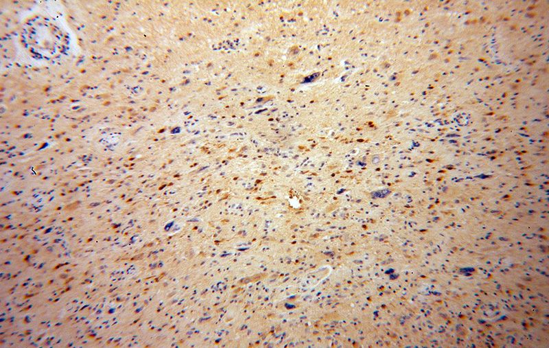 Immunohistochemical of paraffin-embedded human gliomas using Catalog No:107772(ADAP1 antibody) at dilution of 1:100 (under 10x lens)