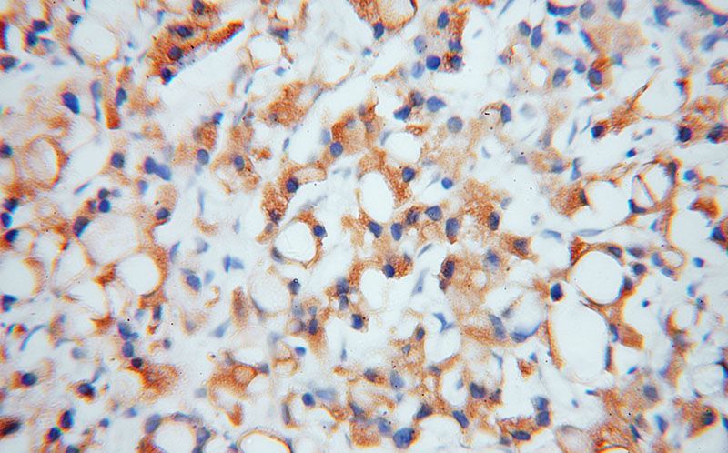 Immunohistochemical of paraffin-embedded human prostate cancer using Catalog No:110178(EIF2A antibody) at dilution of 1:50 (under 40x lens)