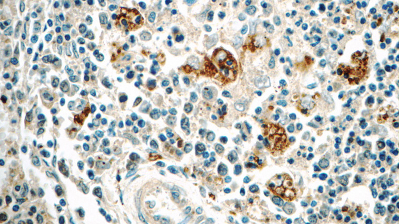 Immunohistochemistry of paraffin-embedded human spleen tissue slide using Catalog No:116844(WAS Antibody) at dilution of 1:50 (under 40x lens)