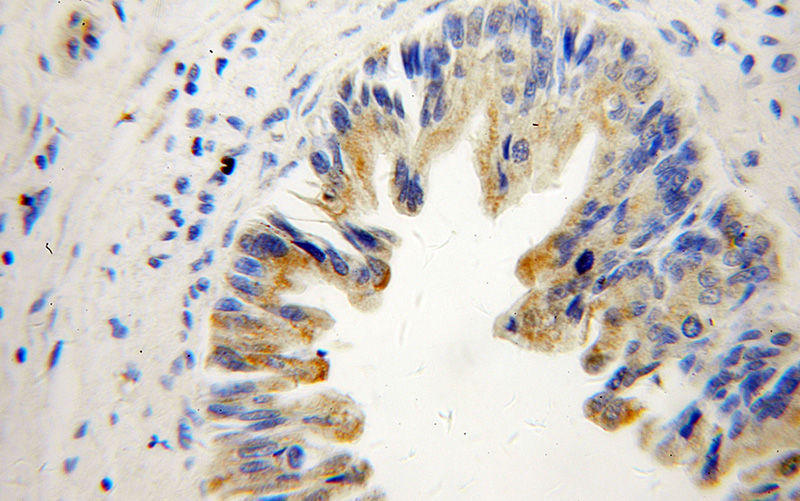 Immunohistochemical of paraffin-embedded human pancreas cancer using Catalog No:115267(SHC3 antibody) at dilution of 1:50 (under 40x lens)