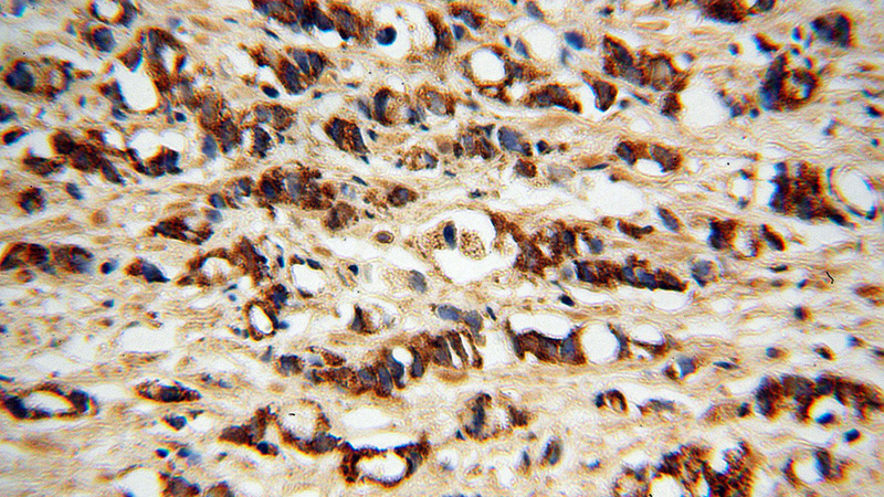 Immunohistochemical of paraffin-embedded human prostate cancer using Catalog No:113675(PDGFD antibody) at dilution of 1:50 (under 40x lens)