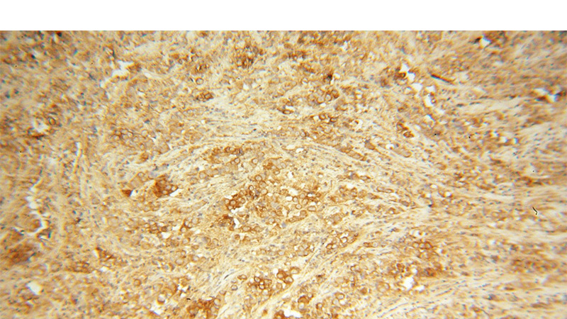 Immunohistochemical of paraffin-embedded human prostate cancer using Catalog No:108810(CDH7 antibody) at dilution of 1:50 (under 10x lens)