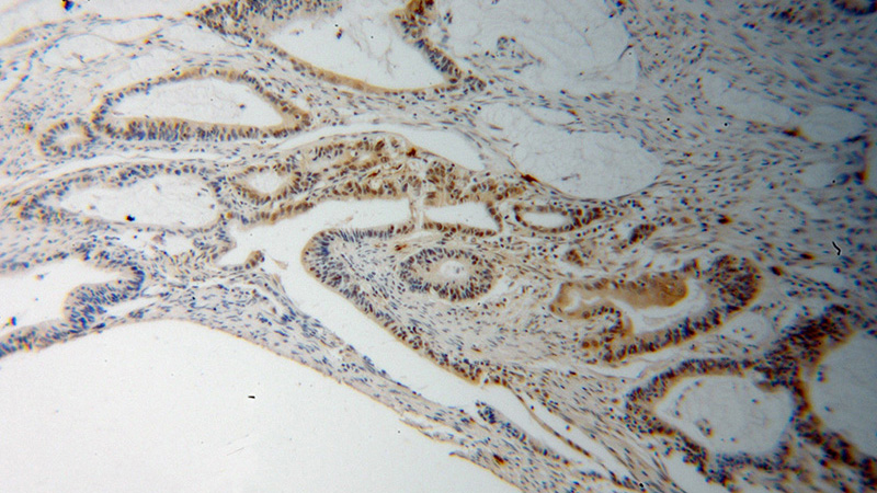 Immunohistochemical of paraffin-embedded human colon cancer using Catalog No:114127(PPIL1 antibody) at dilution of 1:100 (under 10x lens)