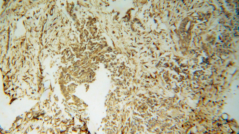Immunohistochemical of paraffin-embedded human breast cancer using Catalog No:110579(FAM175A antibody) at dilution of 1:100 (under 10x lens)