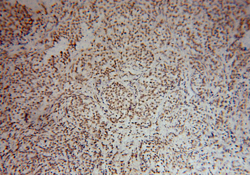 Immunohistochemical of paraffin-embedded human breast cancer using Catalog No:116463(U2AF2 antibody) at dilution of 1:50 (under 10x lens)