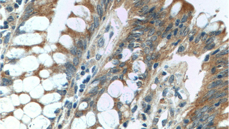 Immunohistochemistry of paraffin-embedded human colon tissue slide using Catalog No:112813(MRPL14 Antibody) at dilution of 1:50 (under 40x lens)