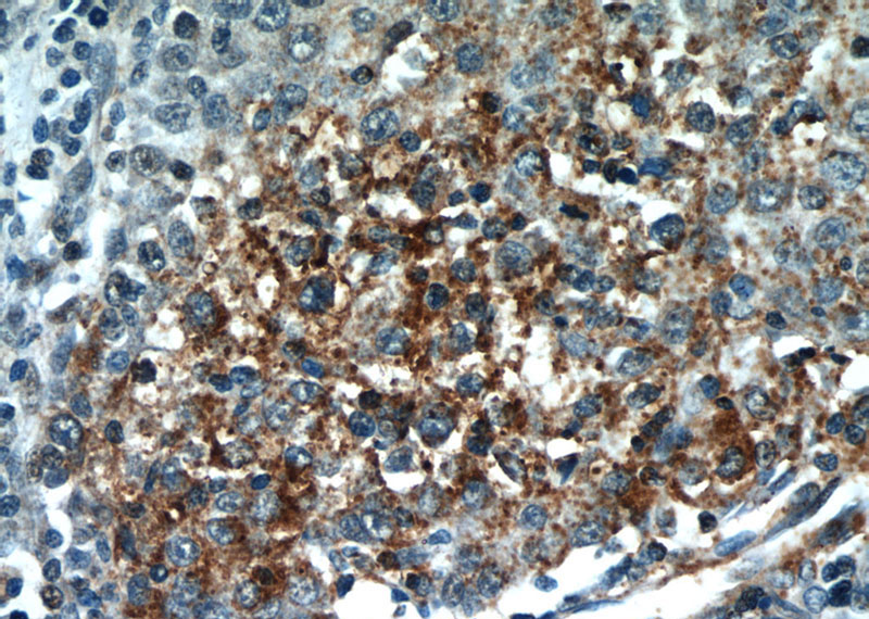 Immunohistochemical of paraffin-embedded human liver cancer using Catalog No:113872(PIK3CB antibody) at dilution of 1:50 (under 40x lens)