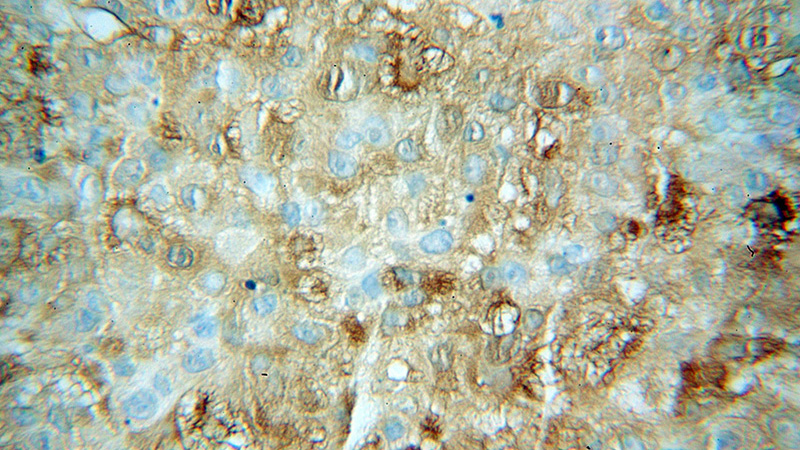 Immunohistochemical of paraffin-embedded human skin cancer using Catalog No:108828(CALML5 antibody) at dilution of 1:500 (under 40x lens)