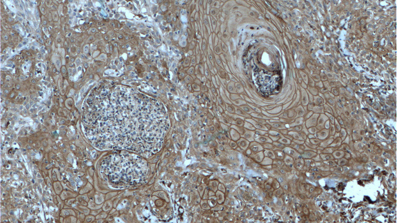 Immunohistochemistry of paraffin-embedded human skin cancer tissue slide using Catalog No:110026(DSG1 Antibody) at dilution of 1:200 (under 10x lens). heat mediated antigen retrieved with Tris-EDTA buffer(pH9).