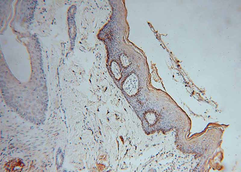 Immunohistochemical of paraffin-embedded human skin cancer using Catalog No:113389(NSUN5 antibody) at dilution of 1:50 (under 10x lens)