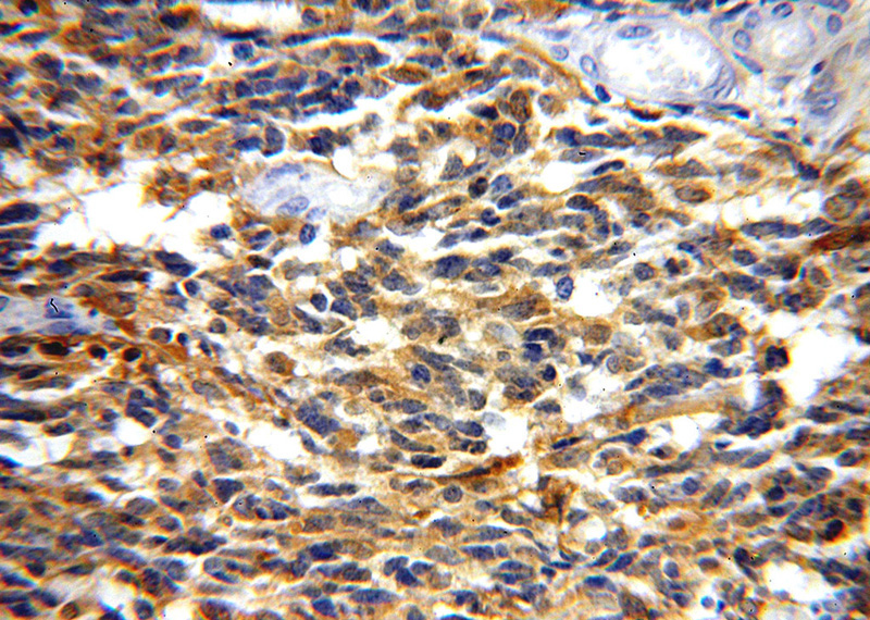 Immunohistochemical of paraffin-embedded human gliomas using Catalog No:109544(CKB-Specific antibody) at dilution of 1:100 (under 40x lens)