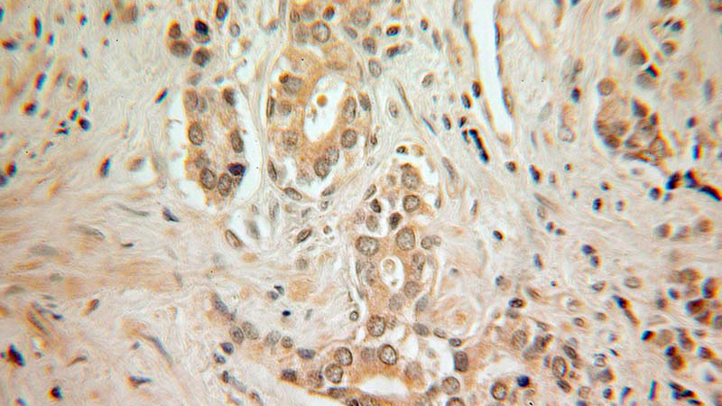 Immunohistochemical of paraffin-embedded human prostate cancer using Catalog No:111558(HSF2 antibody) at dilution of 1:100 (under 25x lens)