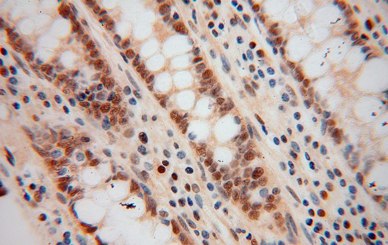 Immunohistochemical of paraffin-embedded human colon cancer using Catalog No:116513(UBE1 antibody) at dilution of 1:50 (under 40x lens)