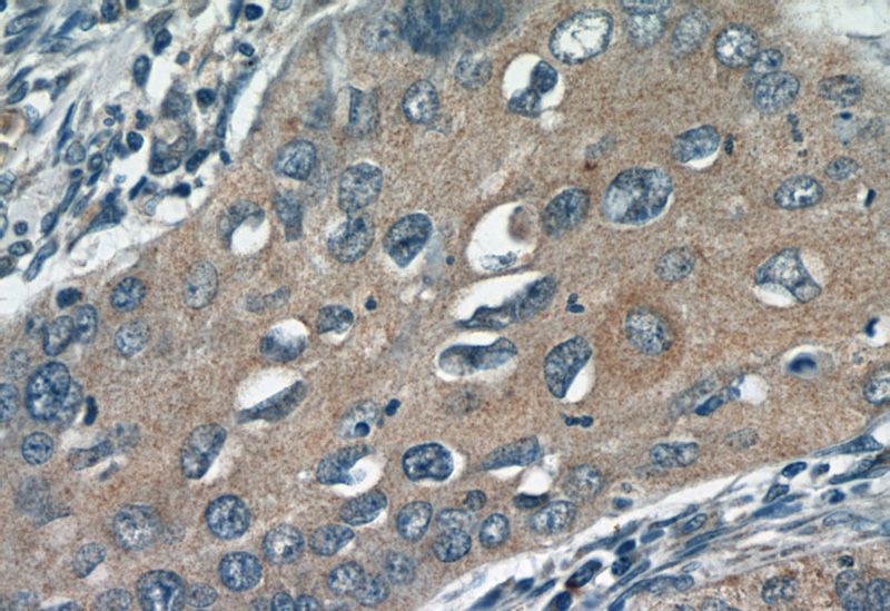 Immunohistochemistry of paraffin-embedded human cervical cancer tissue slide using Catalog No:109938(DIAPH3 Antibody) at dilution of 1:50