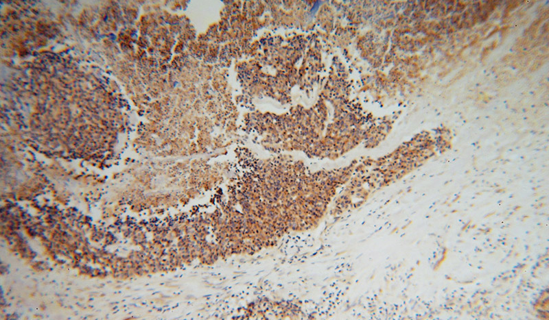 Immunohistochemical of paraffin-embedded human lung cancer using Catalog No:112477(MARCKSL1 antibody) at dilution of 1:50 (under 10x lens)