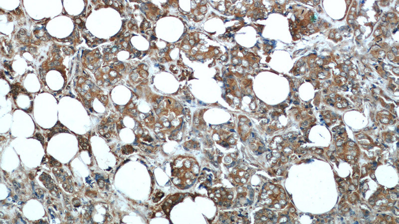 Immunohistochemical of paraffin-embedded human breast cancer using Catalog No:107605(STC2 antibody) at dilution of 1:50 (under 10x lens)