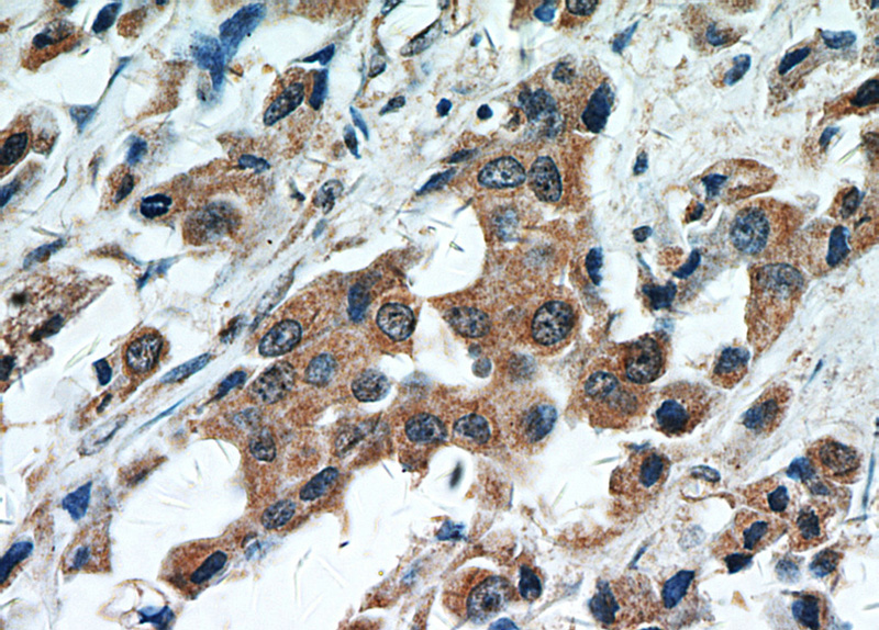 Immunohistochemical of paraffin-embedded human breast cancer using Catalog No:115685(STAT2 antibody) at dilution of 1:50 (under 40x lens)