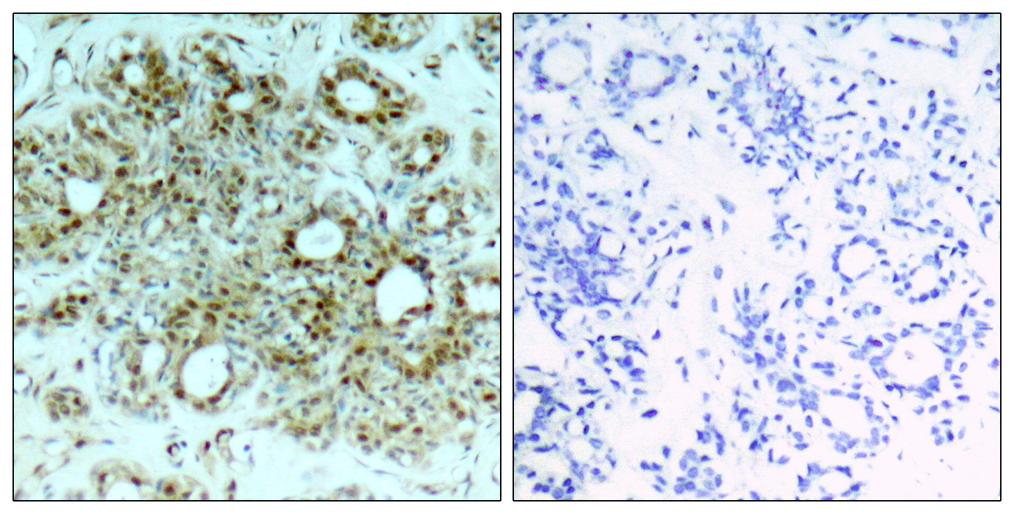 Immunohistochemical analysis of paraffin-embedded human breast carcinoma tissue using NFκB-p65 (Ab-311) Antibody (left) or the same antibody preincubated with blocking peptide (right).